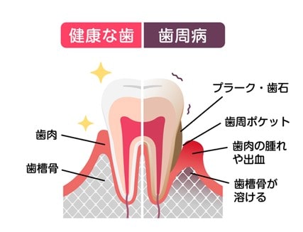健康な歯と歯周病の違い