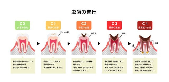 むし歯の進行イメージ図