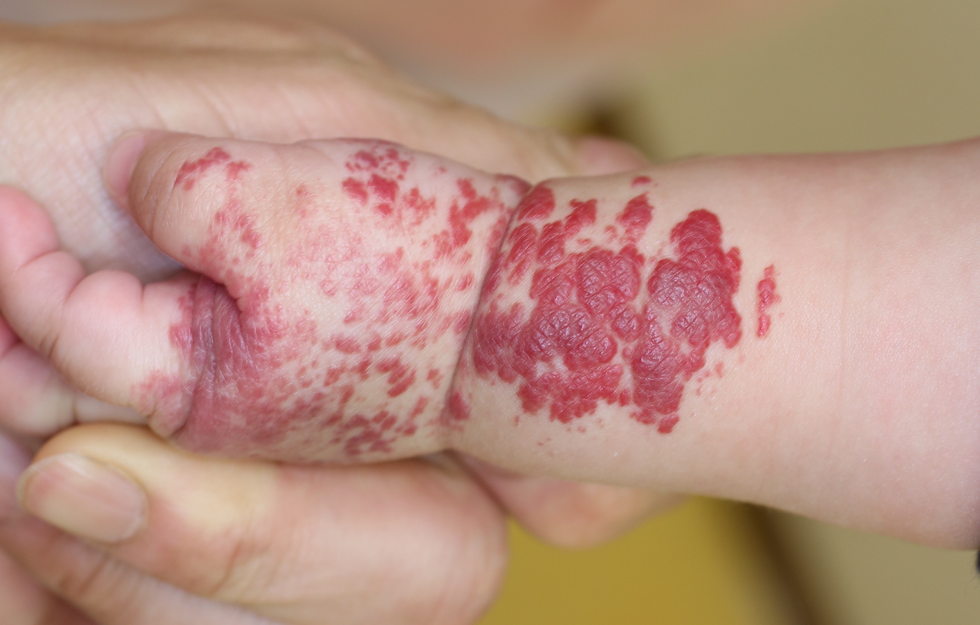 いちご状血管腫 - 牛込パーククリニック 