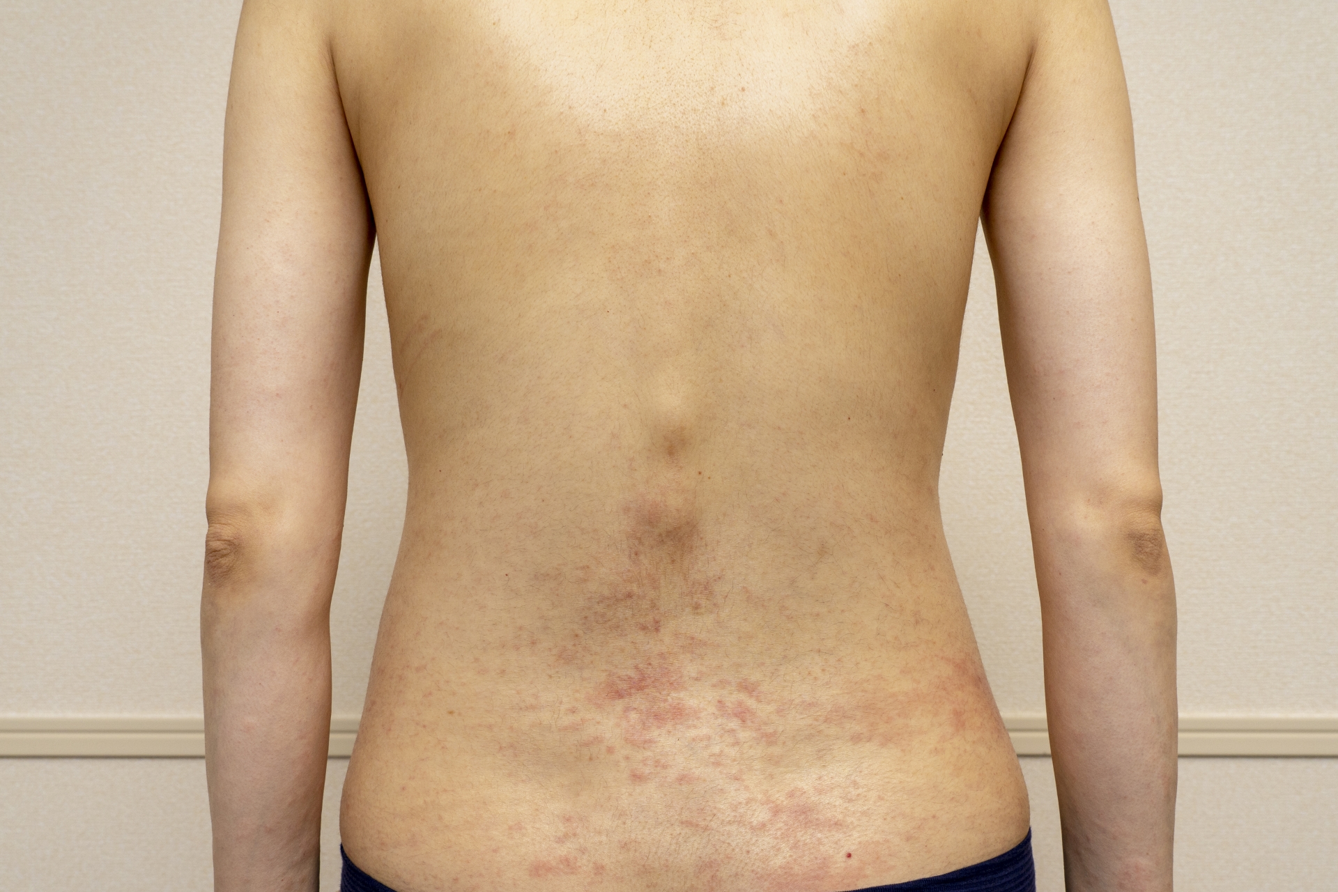 皮膚のリンパ腫 最新分類に基づく診療ガイド 皮膚のリンパ腫 最新分類に基づく診療ガイド がん診療