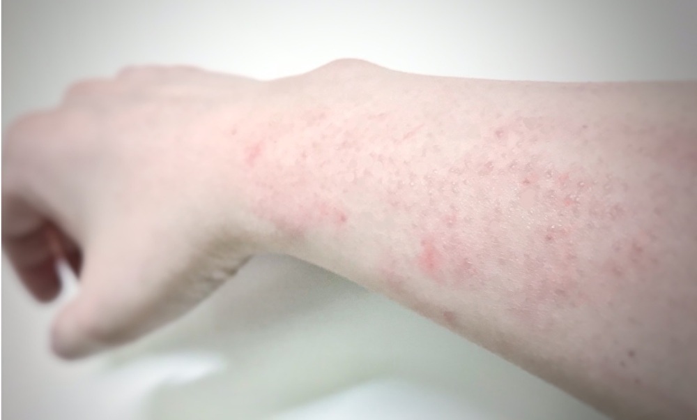 菌状息肉症 牛込パーククリニック